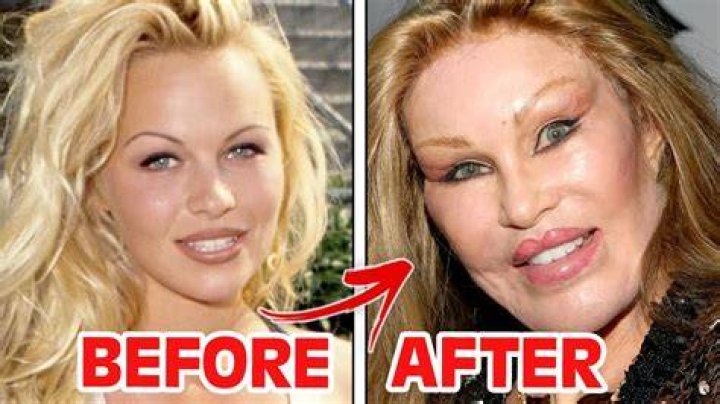 Understanding the Worst Aesthetic Surgery: Common Mistakes and Consequences
